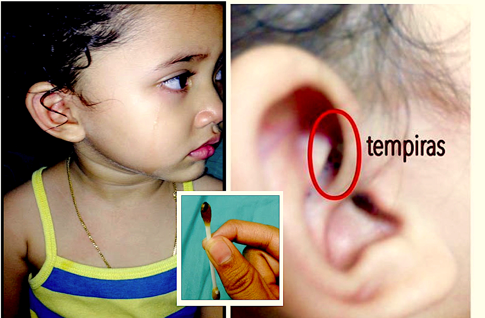 sajagempak.com - Anak Mengadu Sakit Di Telinga, Ibu Terkejut Jumpa Sarang Tempiras Dalam Telinga Anak, Sampai Sudah Bertelur
