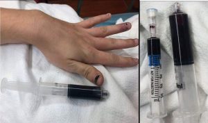 sajagempak.com - Bermula Dari Sakit Gigi, Doktor Terkejut Darah Wanita Bertukar Biru Sebelum Tubuhnya Juga Menjadi Kebiruan