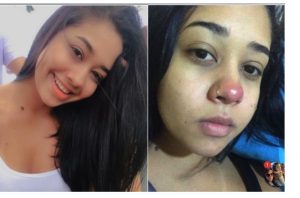 sajagempak.com - Kerana Tindik Hidung, Gadis Terpaksa Berkerusi Roda Seumur Hidup
