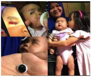 sajagempak.com - “Perasan Ada Lingkaran Gelap Berhampiran Mata..” Bila Buka Lampu, Ibu Terkejut Bebola Mata Anak Terkeluar