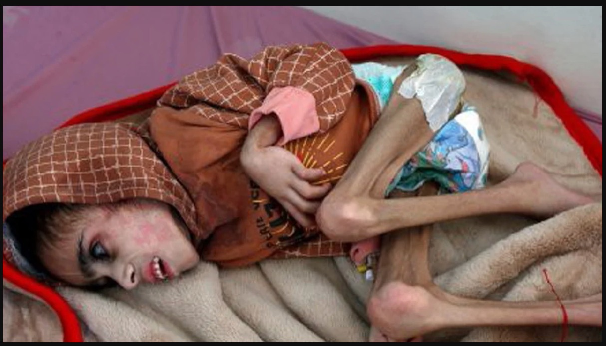 sajagempak.com - Menyedihkan Kanak-kanak Dijumpai Dalam Keadaan Kurus Kering Kelaparan