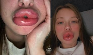 Ibu Dua Anak Hampir Pengsan, Bibir Bengkak 3 Kali Ganda Selepas Buat Rawatan Kecantikan
