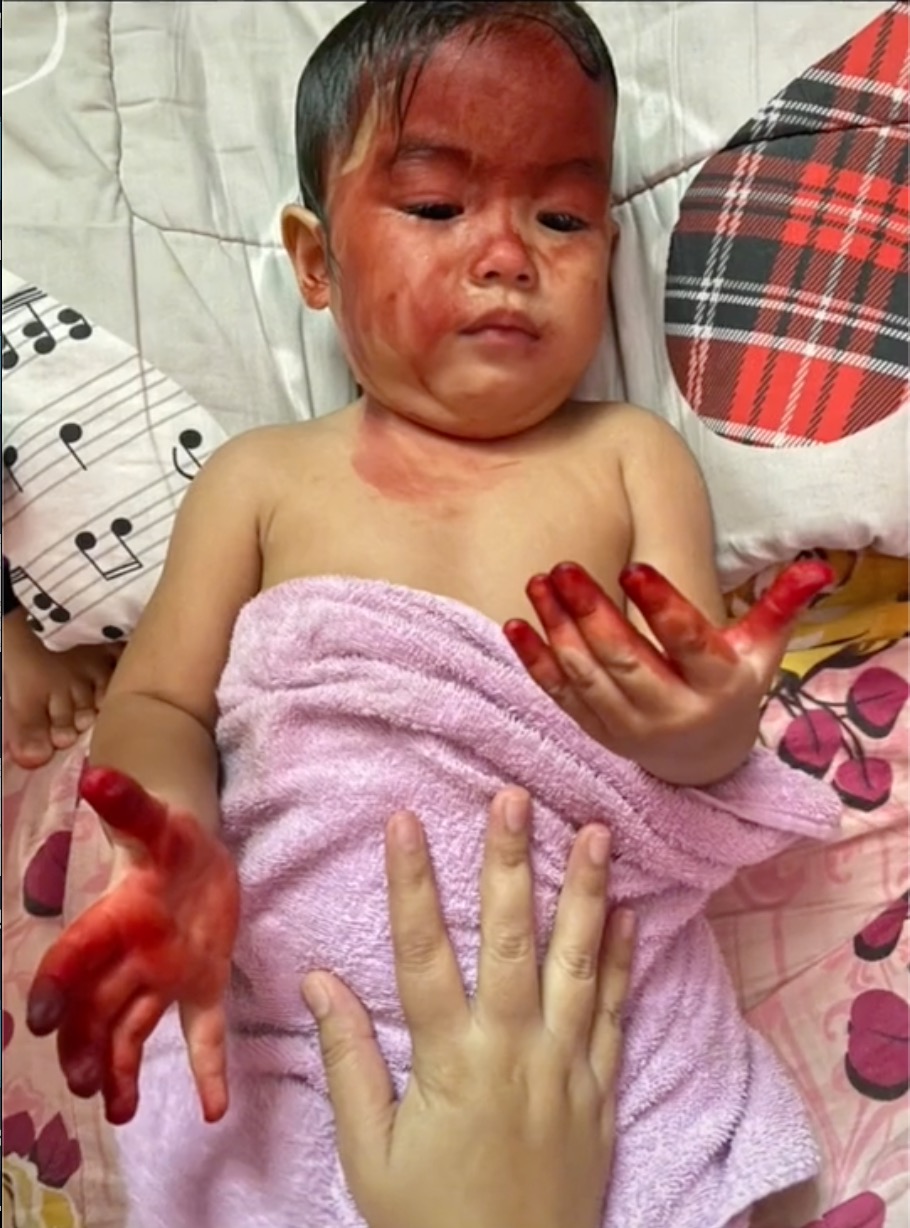 Ibu Cemas Wajah Anak Dipenuhi Cecair Merah Seakan Darah - sajagempak.com